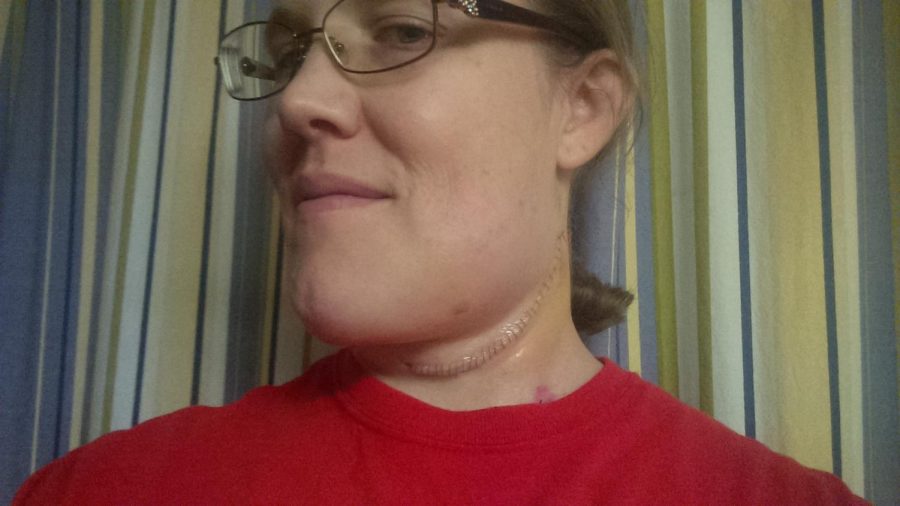 Dannyes neck and drain scar with the stitches still in.